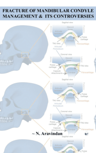 Fracture Of Mandibular Condyle Management & Its Controversies