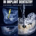 surgical guides in implant dentistry: guided implant surgery