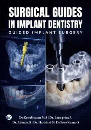 surgical guides in implant dentistry: guided implant surgery